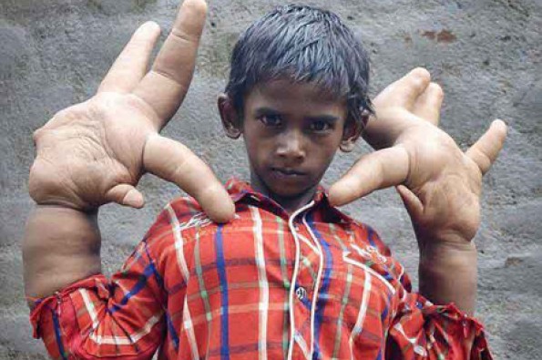 پسر 8 ساله هندی با دست های عظیم